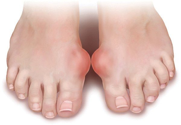bệnh gút không được dùng cao hươu bệnh gút không được dùng cao hươu