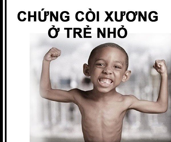 nhung hươu chữa bệnh còi xương ở trẻ